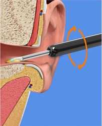 מכשיר חדשני להסרת שעוות אוזניים עם מצלמה 1296P